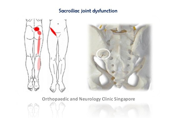 Sacroiliac Joint Dysfunction Professional Spine Clinic